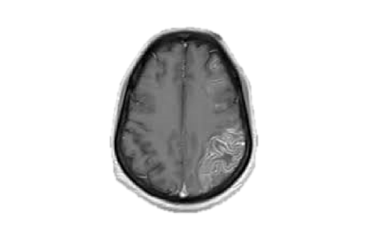 First conference on ischemic stroke