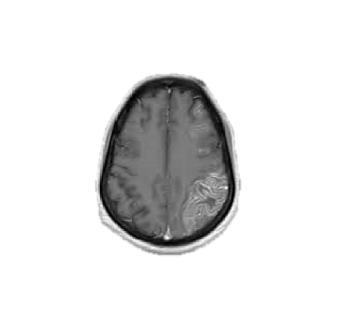 First conference on ischemic stroke